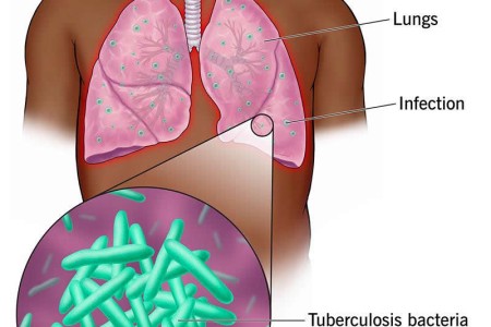 Tuberculosis