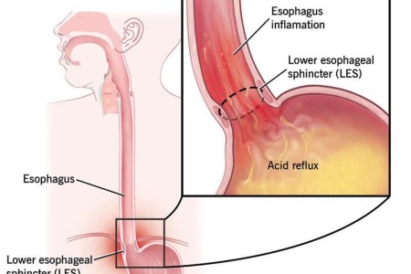 Indigestion (Dyspepsia)