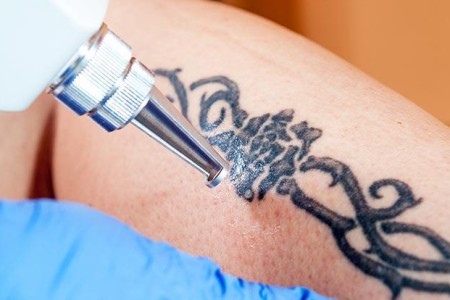 Tattoo Removal