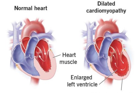 Dilated Cardiomyopathy