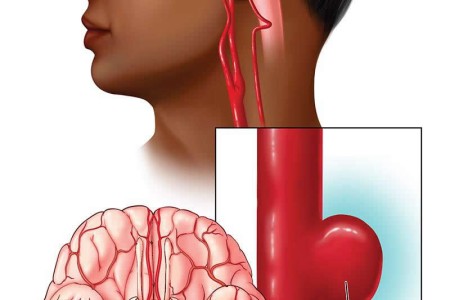 Brain Aneurysm