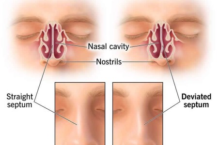 Deviated Septum