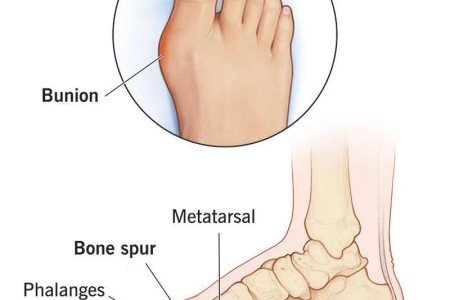 Hallux Rigidus