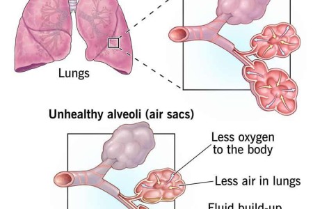 Acute Respiratory Distress Syndrome (ARDS)