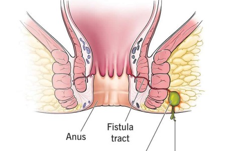 Anal Fistula