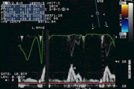 Dobutamine Stress Echocardiogram