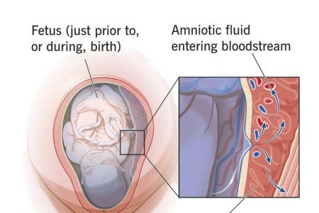 Amniotic Fluid Embolism (Anaphylactic Syndrome of Pregnancy)