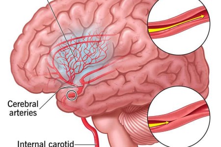 Moyamoya Disease
