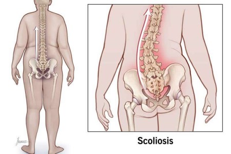 Scoliosis