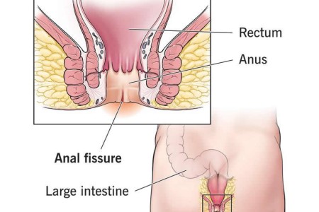 Anal Fissures