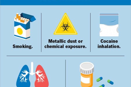 Goodpasture Syndrome (Anti-GBM Disease)