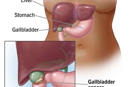 Gallbladder Cancer