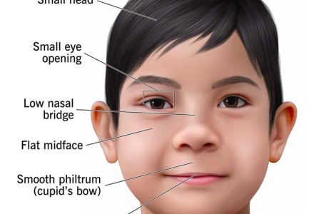 Fetal Alcohol Syndrome