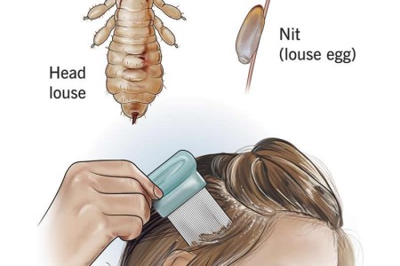 Head Lice