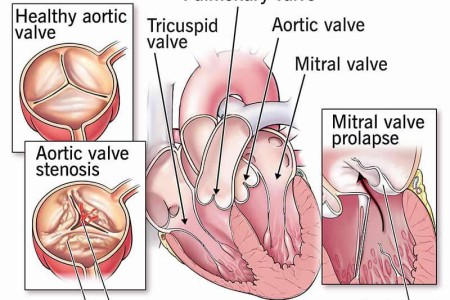 Heart Valve Disease