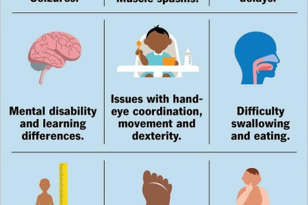 Lissencephaly