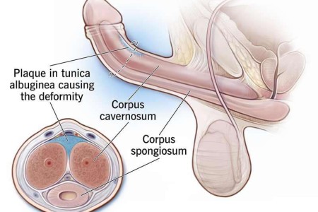 Peyronie's Disease
