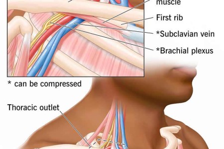 Thoracic Outlet Syndrome