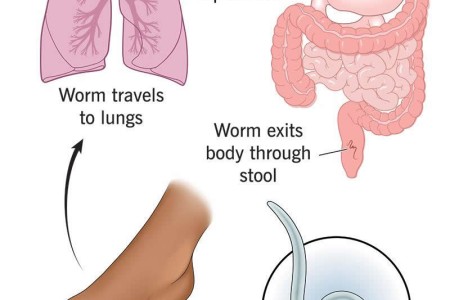 Hookworm Disease