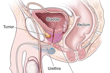 Prostate Cancer