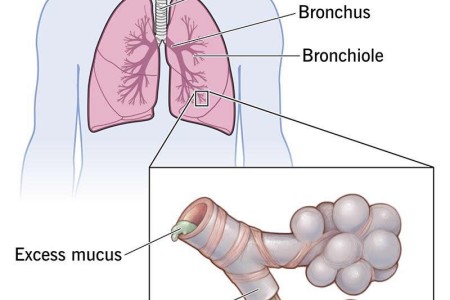 Bronchitis