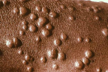Smallpox