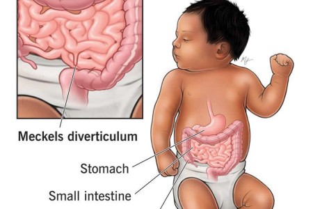 Meckel's Diverticulum