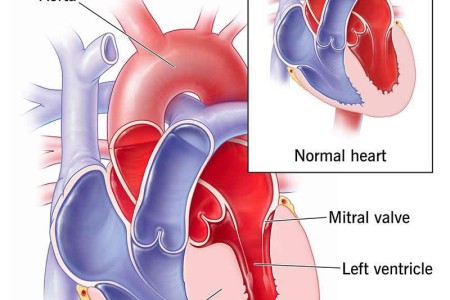 Hypertrophic Cardiomyopathy
