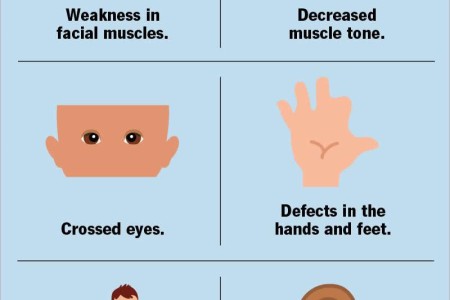 Moebius Syndrome