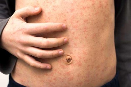 Measles (Rubeola)