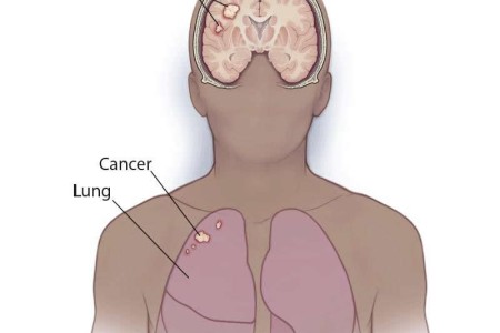 Brain Metastases