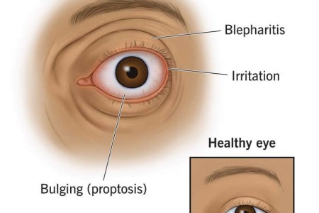 Thyroid Eye Disease (Graves’ Eye Disease)