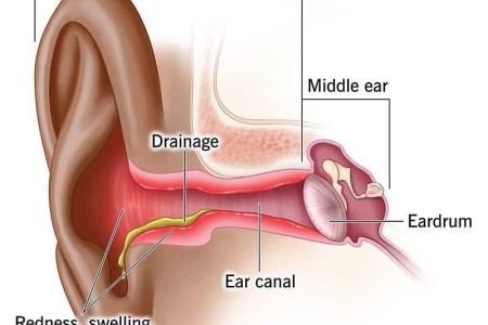 Swimmer’s Ear (Otitis Externa)