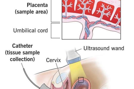 Chorionic Villus Sampling for Prenatal Diagnosis