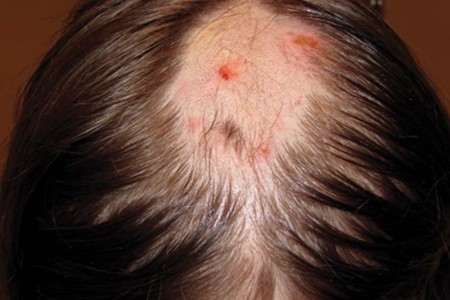 Trichotillomania