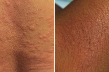 Hives
