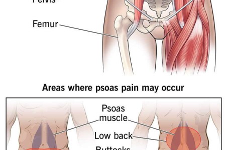 Psoas Syndrome