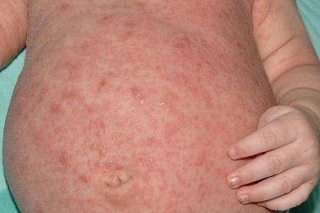 Scabies