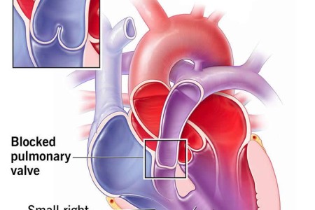 Pulmonary Atresia