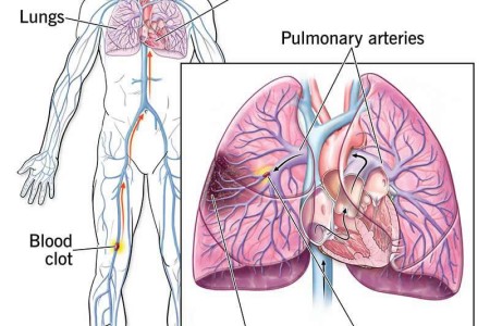 Pulmonary Embolism