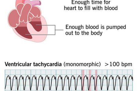 Ventricular Tachycardia