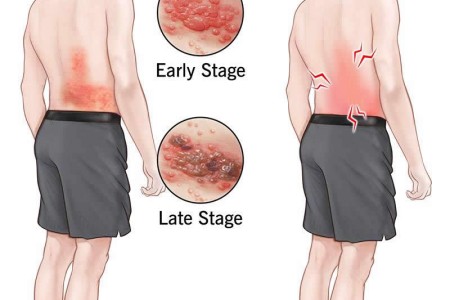 Postherpetic Neuralgia