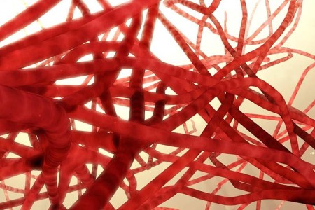 Vascular Disease (Vasculopathy)