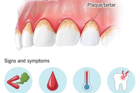 Gingivitis