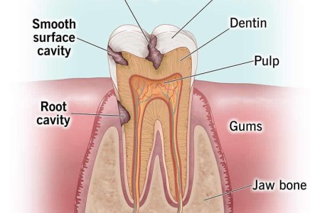 Cavities