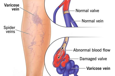 Varicose Veins