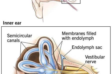 Ménière’s Disease