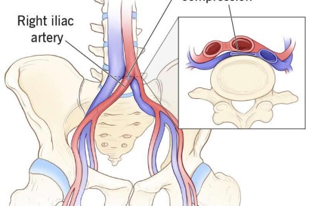 May-Thurner Syndrome