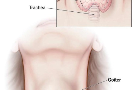Goiter