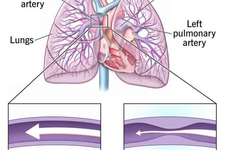 Pulmonary Artery Stenosis